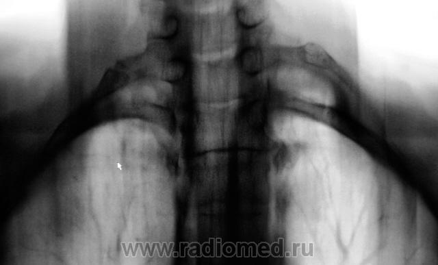 liječenje reber vertebralne artroze)