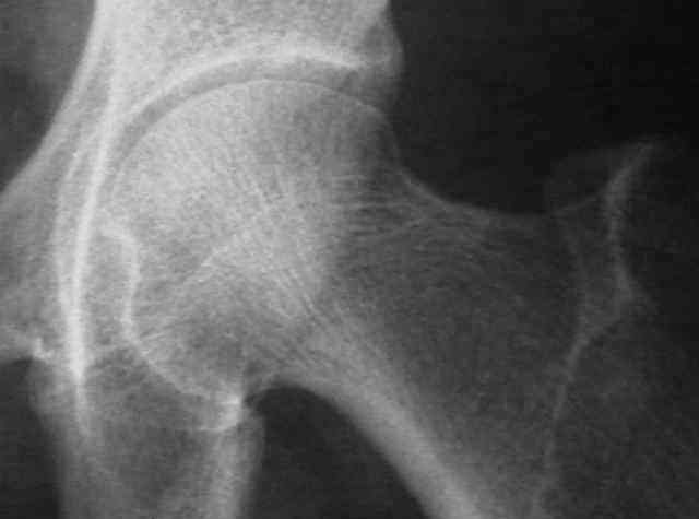 artroza posttraumatică a articulației subtalare