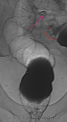 Как объясните отмеченные «полиповидные объекты» в сигме?
