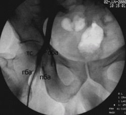 правая бедренная артерия