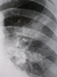 Фрагмент рентгенограммы в прямой проекции.