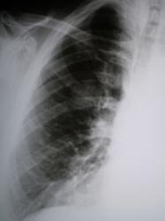3.Рентгенограмма правого лёгкого.