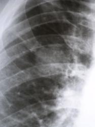 4.Фрагмент рентгенограммы правого лёгкого с увеличением.