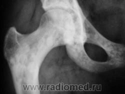 3.Osteopoykiliya.jpg