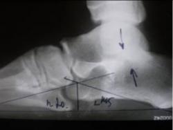 3. боковая рентгенограмма стопы, произведенная в положении стоя (под нагрузкой)