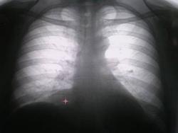 1. прямая цифровая флюорограмма органов грудной полости